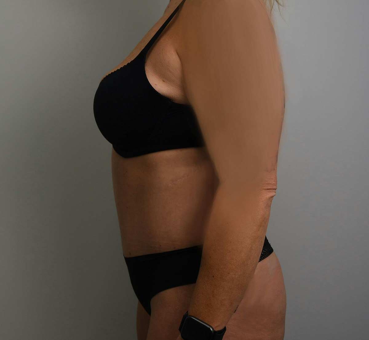 Tummy Tuck Before & After Gallery - Patient 323128 - Image 10