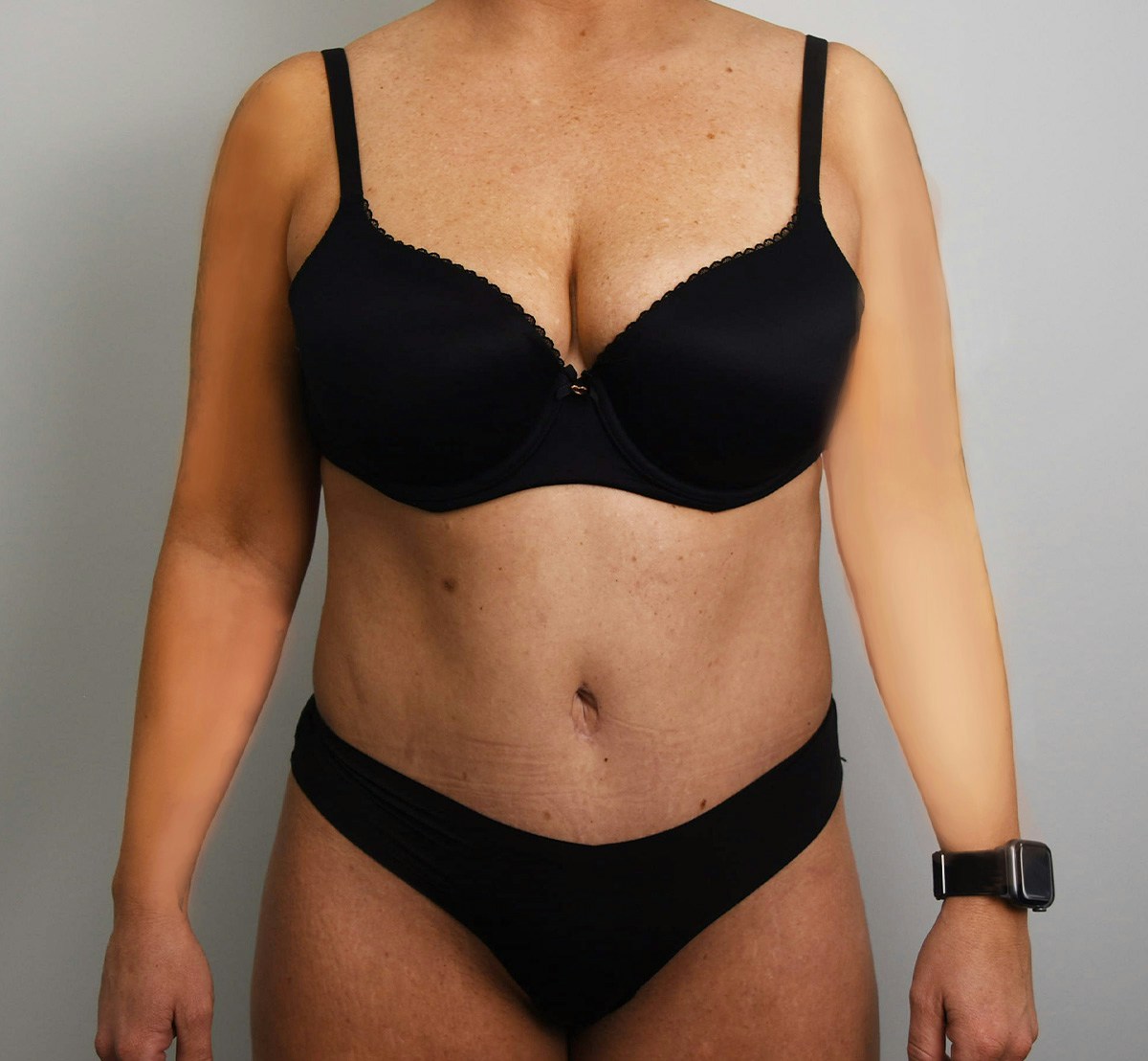 Tummy Tuck Before & After Gallery - Patient 323128 - Image 2