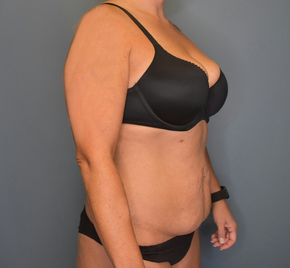 Tummy Tuck Before & After Gallery - Patient 323128 - Image 3