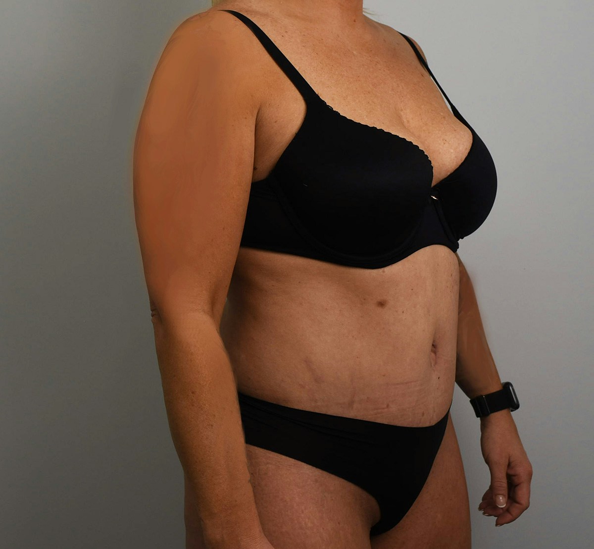 Tummy Tuck Before & After Gallery - Patient 323128 - Image 4