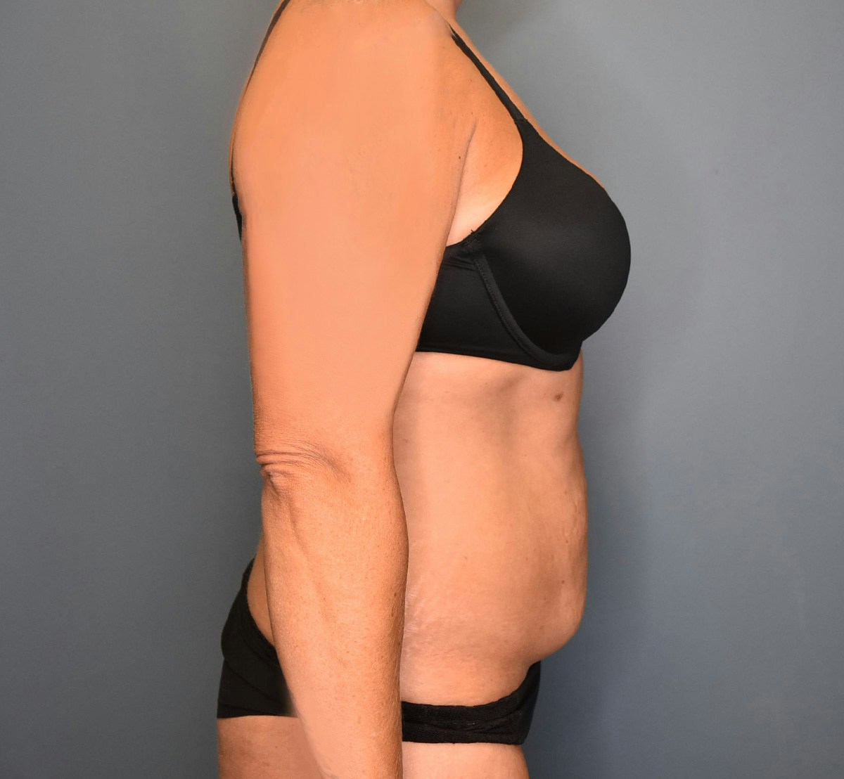 Tummy Tuck Before & After Gallery - Patient 323128 - Image 5