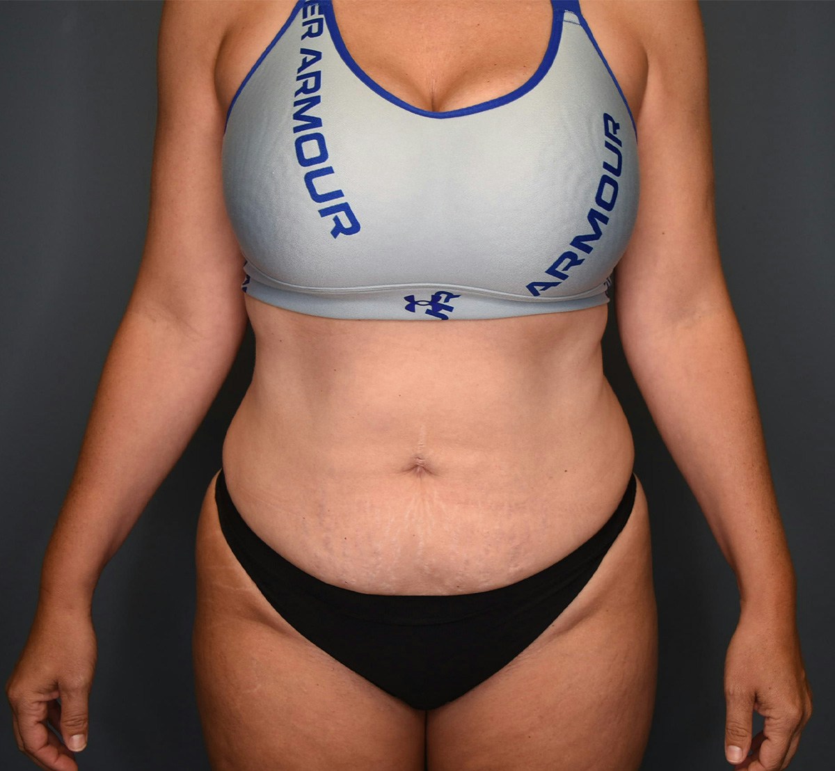 Tummy Tuck Before & After Gallery - Patient 236424 - Image 1