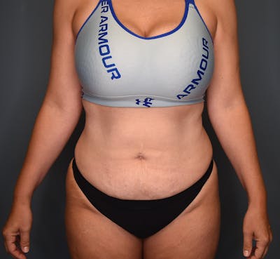 Tummy Tuck Before & After Gallery - Patient 236424 - Image 1