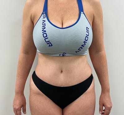 Tummy Tuck Before & After Gallery - Patient 236424 - Image 2
