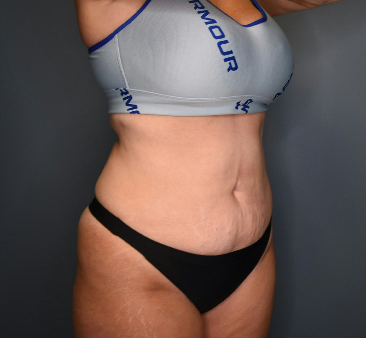 Tummy Tuck Before & After Gallery - Patient 236424 - Image 3