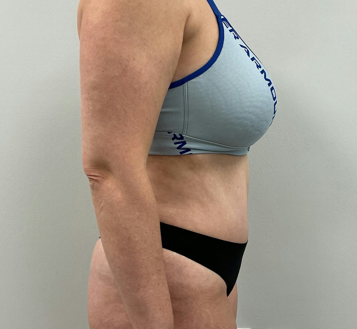 Tummy Tuck Before & After Gallery - Patient 236424 - Image 6