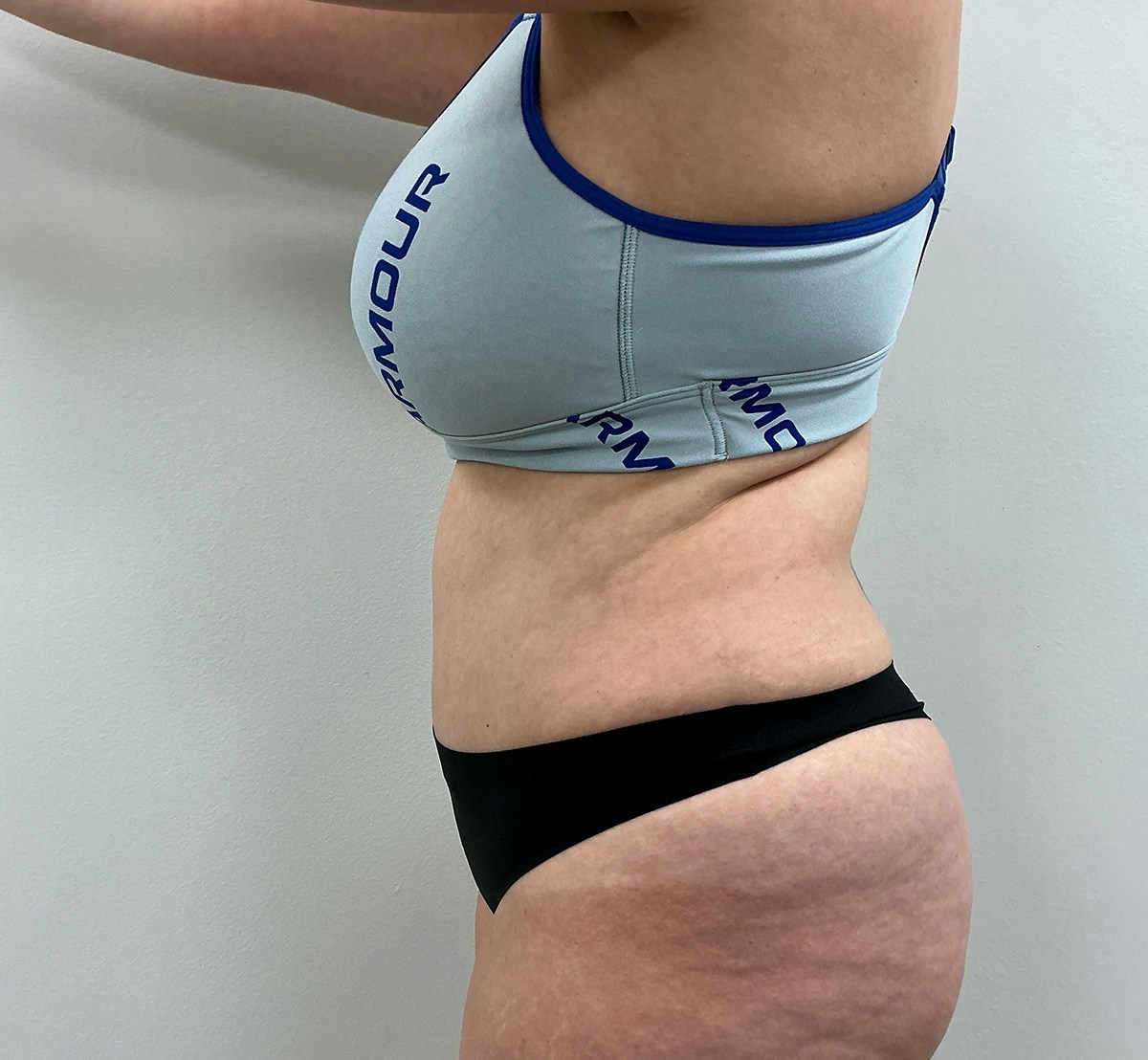 Tummy Tuck Before & After Gallery - Patient 236424 - Image 10
