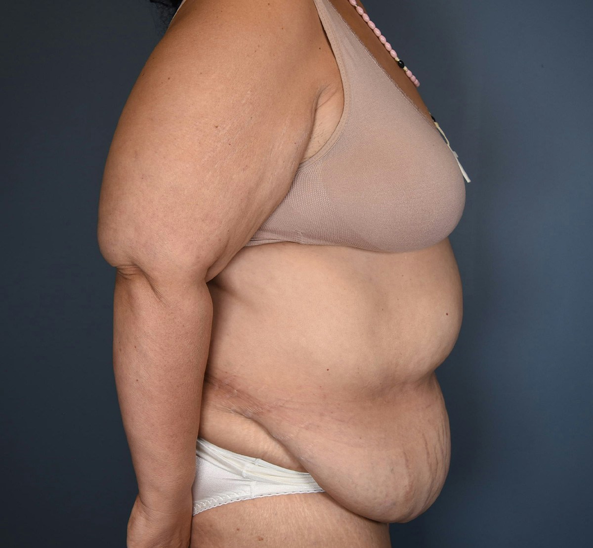 Tummy Tuck Before & After Gallery - Patient 388106 - Image 3