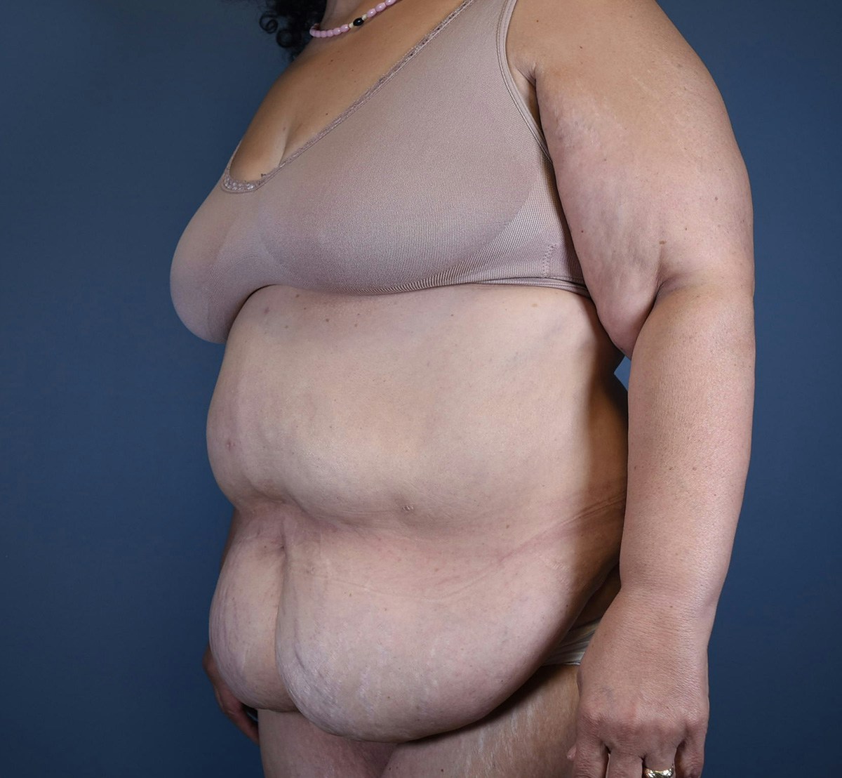 Tummy Tuck Before & After Gallery - Patient 388106 - Image 5