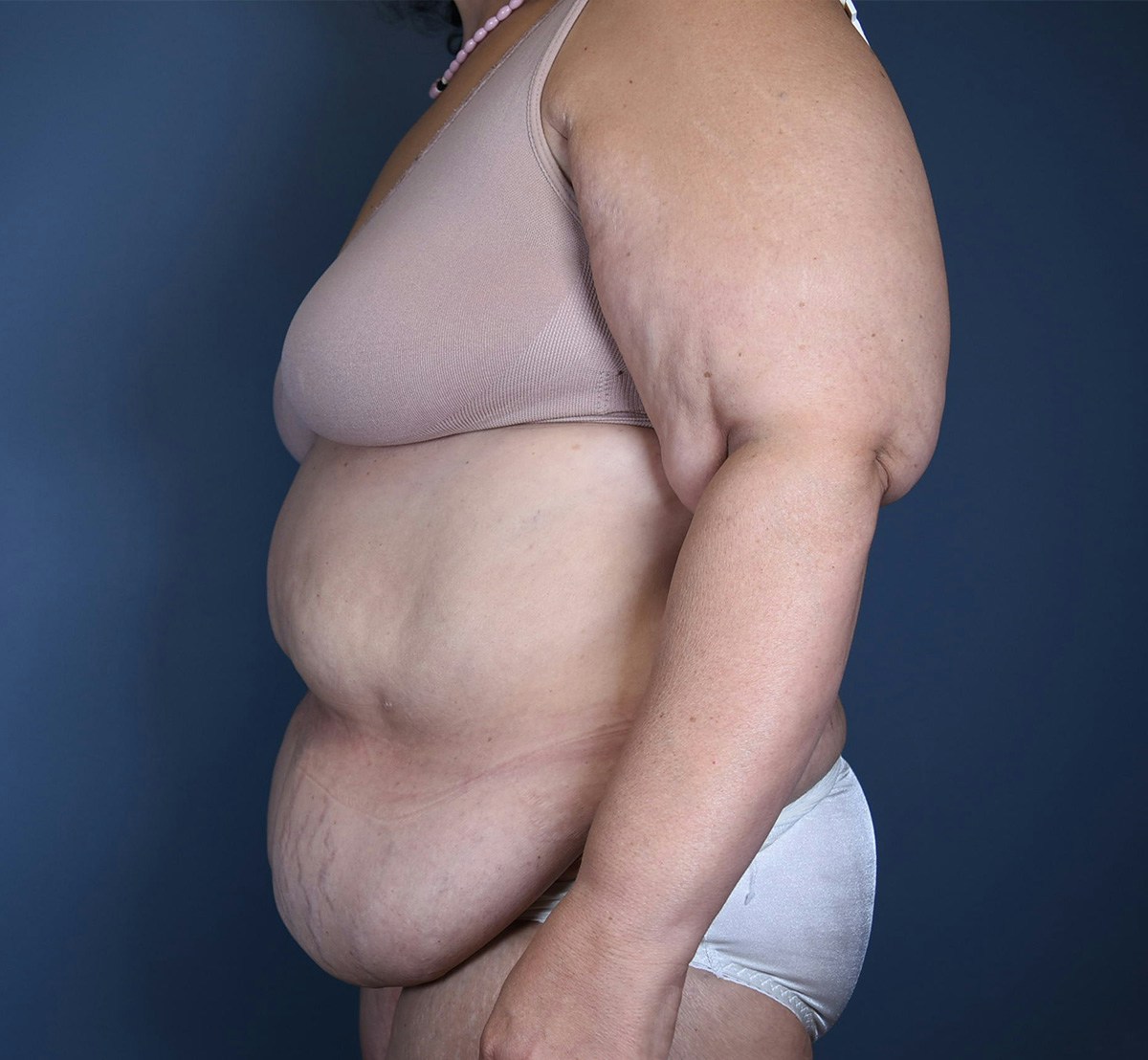 Tummy Tuck Before & After Gallery - Patient 388106 - Image 7