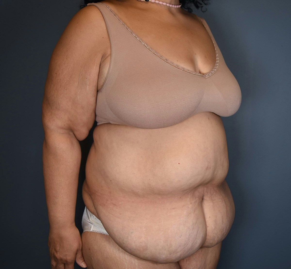 Tummy Tuck Before & After Gallery - Patient 388106 - Image 1