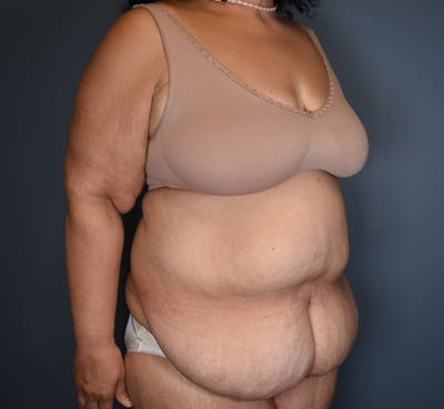 Tummy Tuck Before & After Gallery - Patient 388106 - Image 1