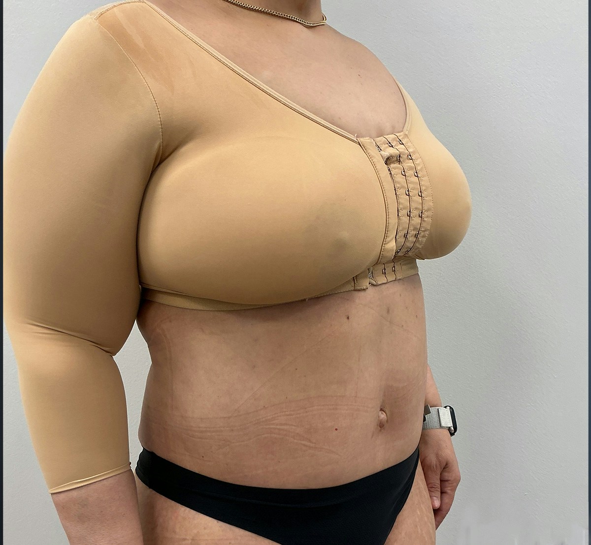 Tummy Tuck Before & After Gallery - Patient 388106 - Image 2