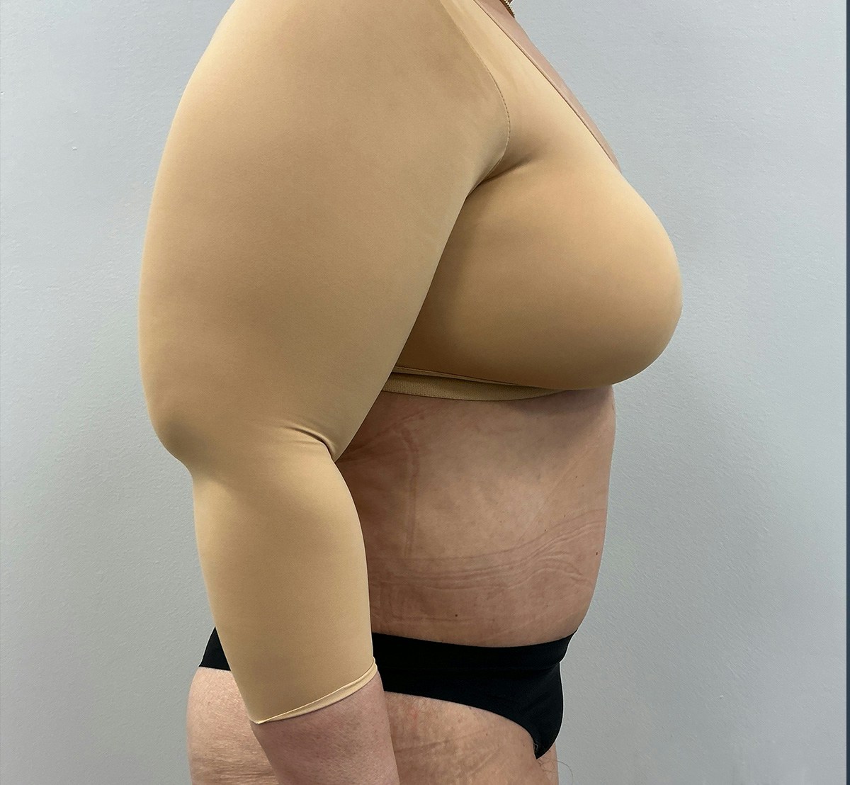 Tummy Tuck Before & After Gallery - Patient 388106 - Image 4