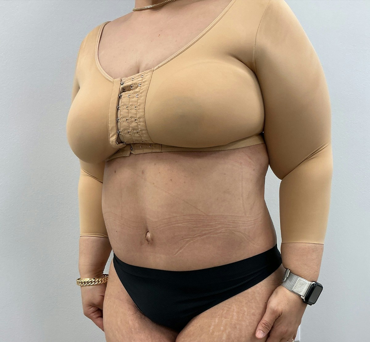 Tummy Tuck Before & After Gallery - Patient 388106 - Image 6