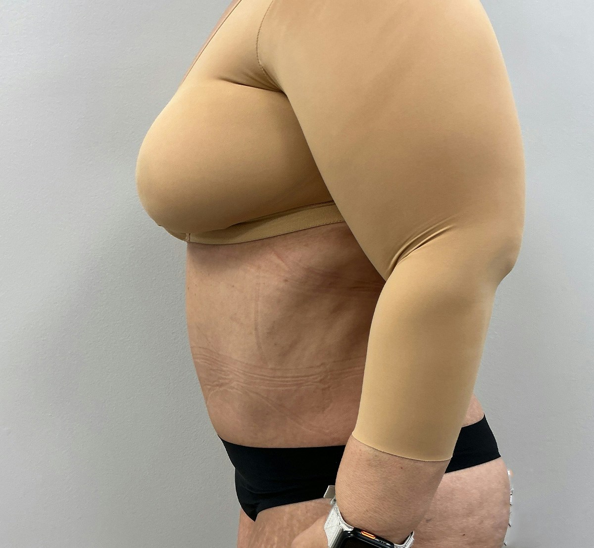 Tummy Tuck Before & After Gallery - Patient 388106 - Image 8