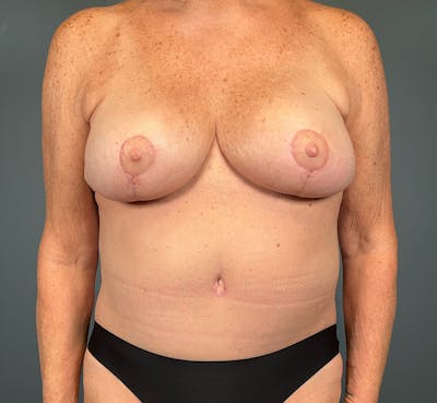 Tummy Tuck Before & After Gallery - Patient 291891 - Image 2