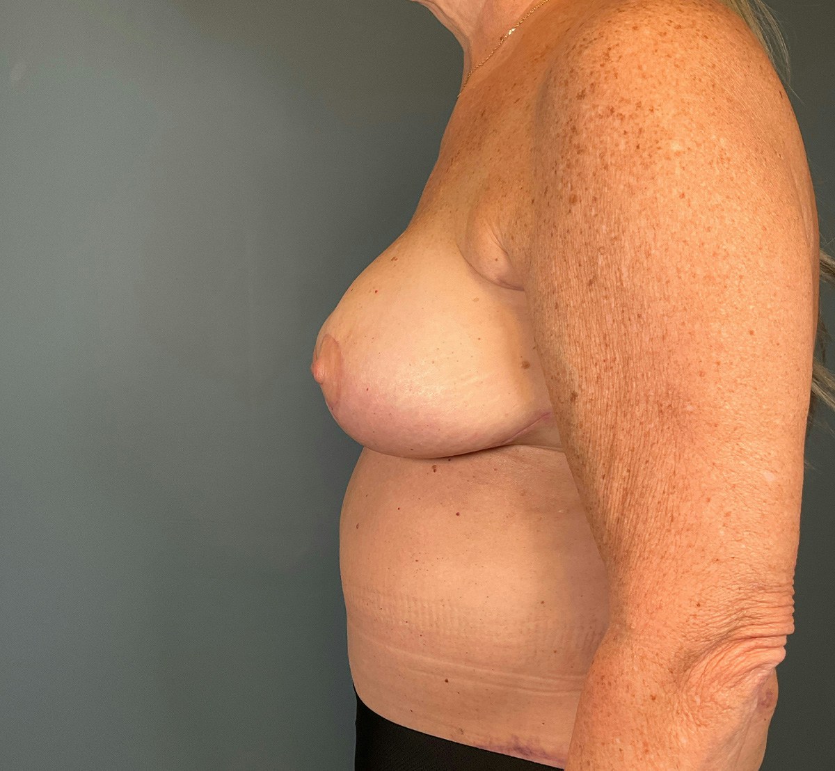 Tummy Tuck Before & After Gallery - Patient 291891 - Image 10