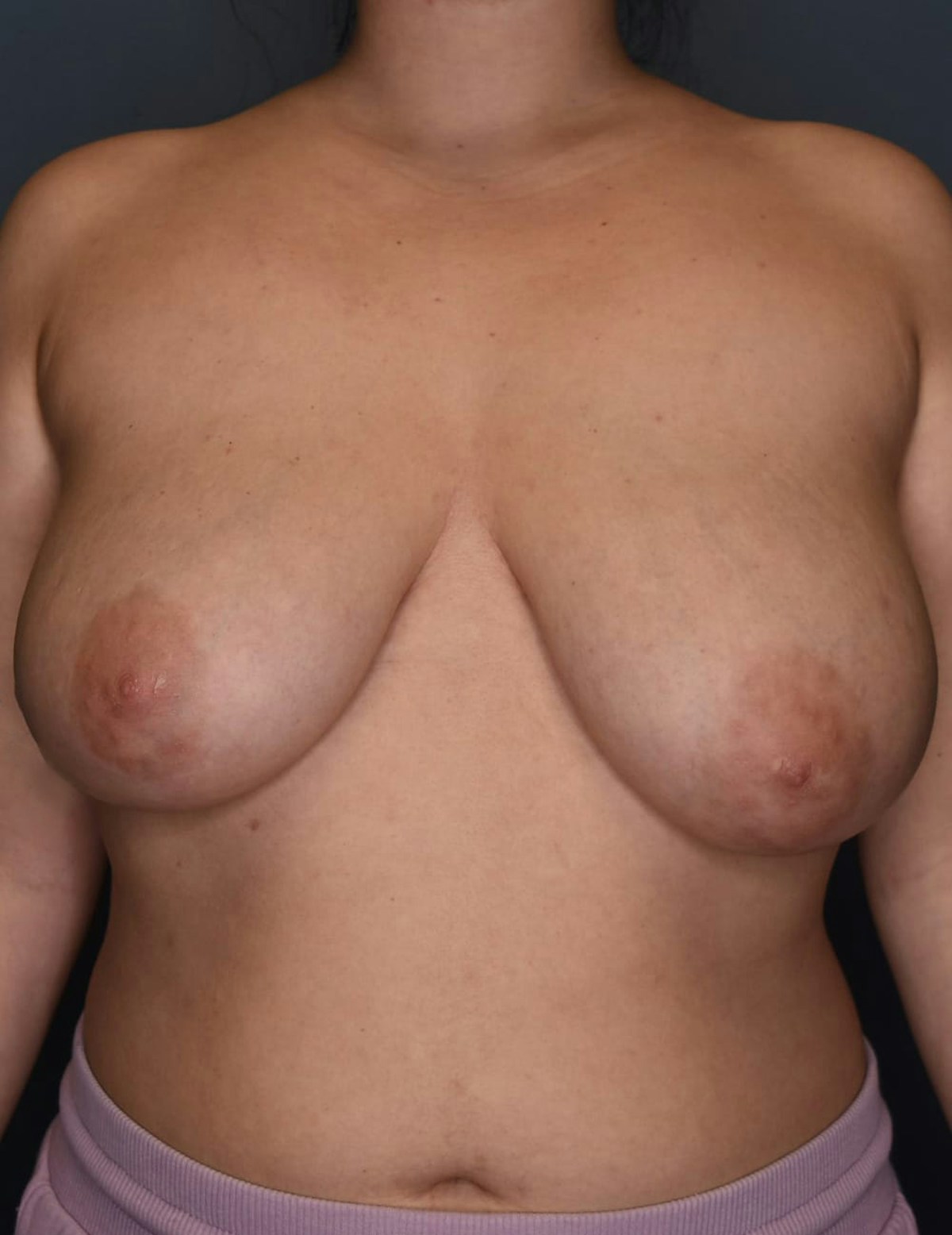 Breast Reduction Before & After Gallery - Patient 700138 - Image 9