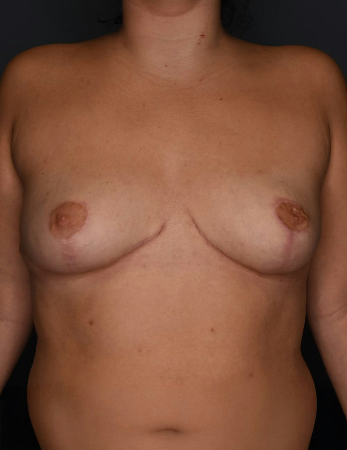 Breast Reduction Before & After Gallery - Patient 700138 - Image 10