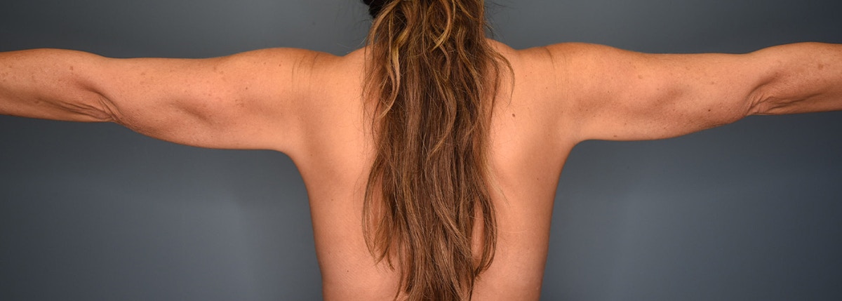 Liposuction Before & After Gallery - Patient 302719 - Image 2