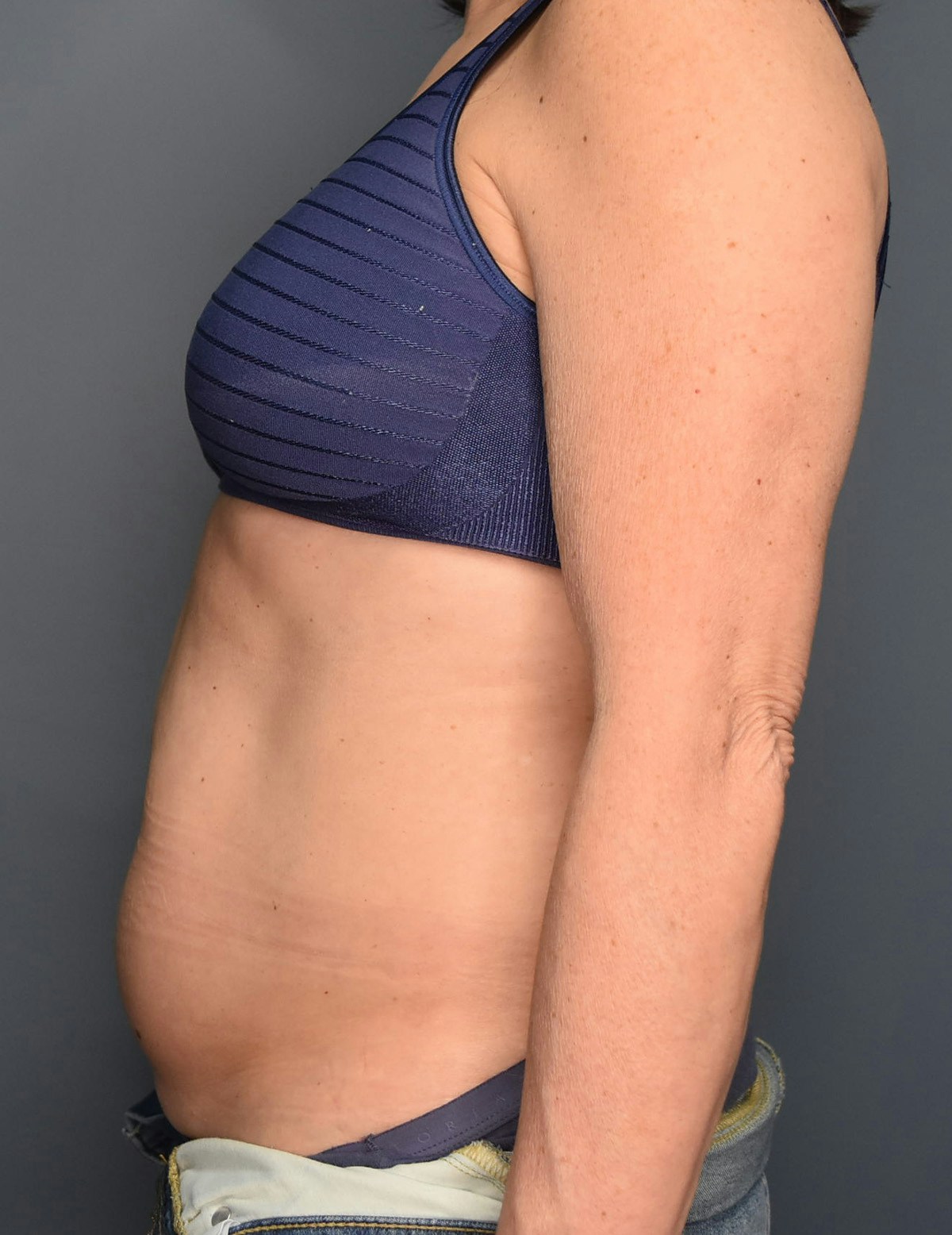 Liposuction Before & After Gallery - Patient 296319 - Image 1