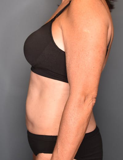 Liposuction Before & After Gallery - Patient 296319 - Image 2
