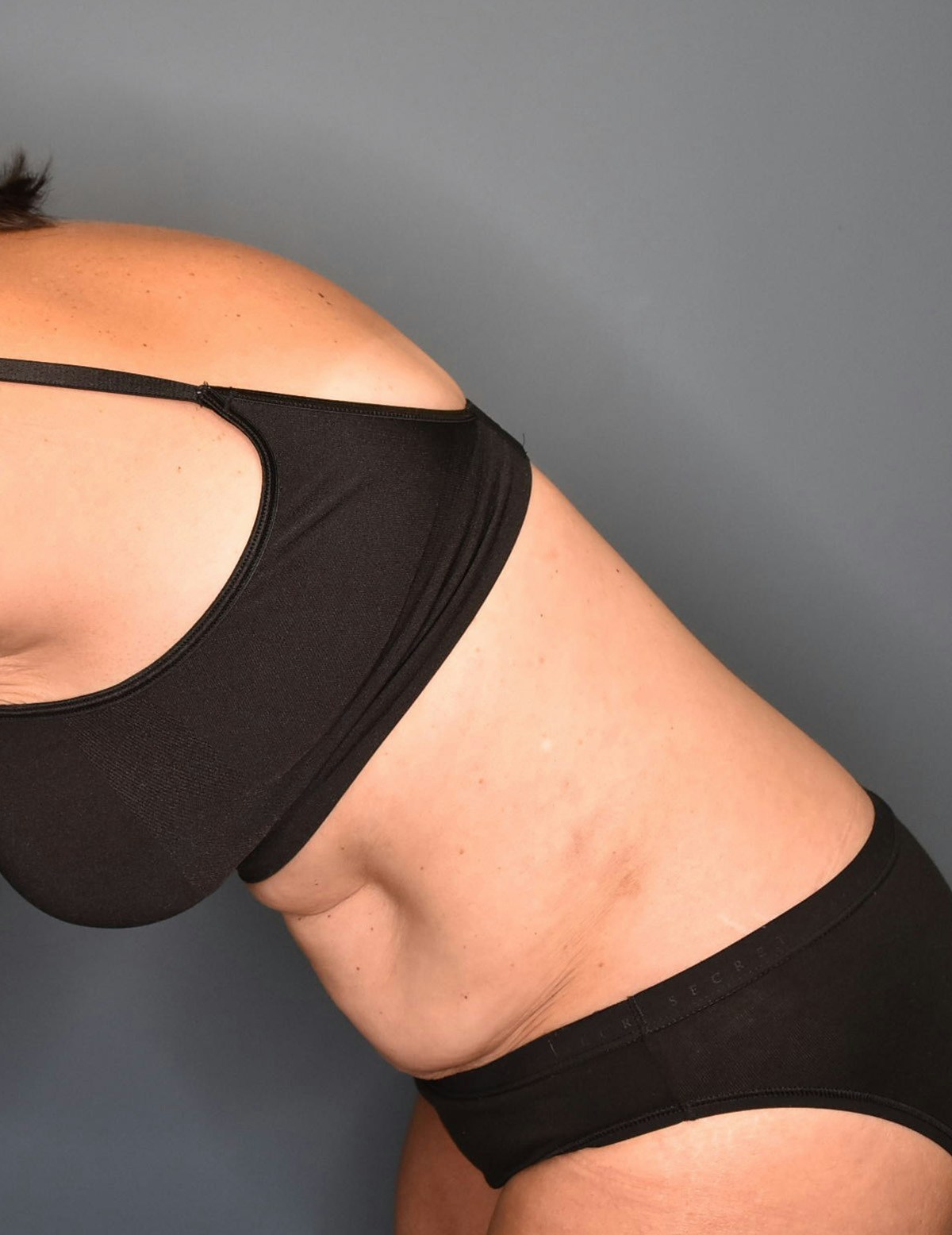 Liposuction Before & After Gallery - Patient 296319 - Image 4