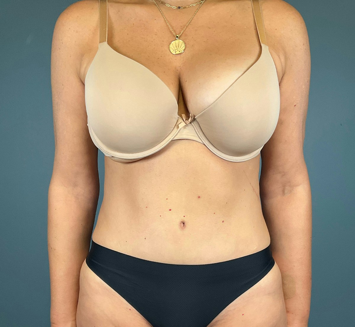 Tummy Tuck Before & After Gallery - Patient 414282 - Image 2