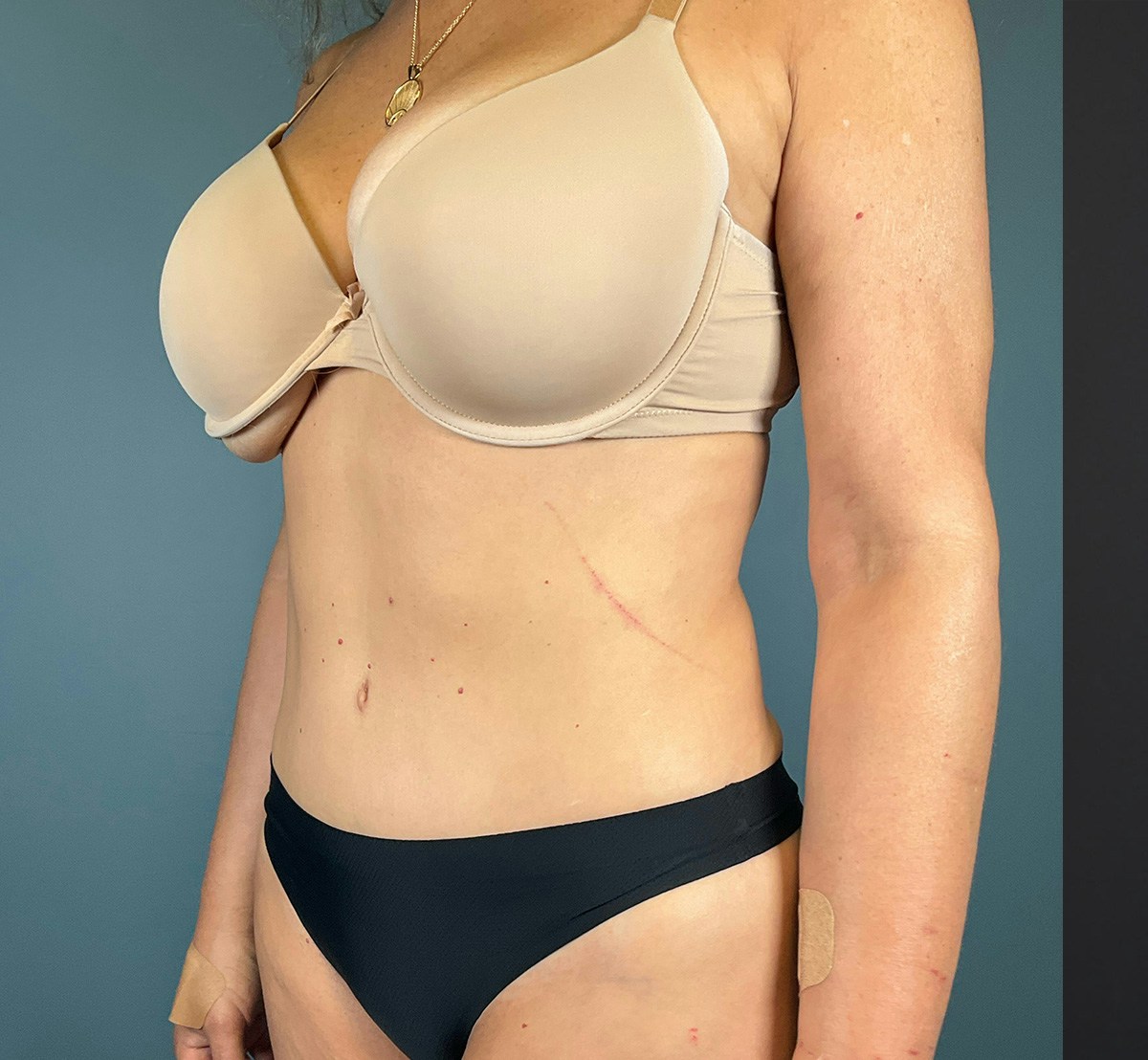 Tummy Tuck Before & After Gallery - Patient 414282 - Image 4