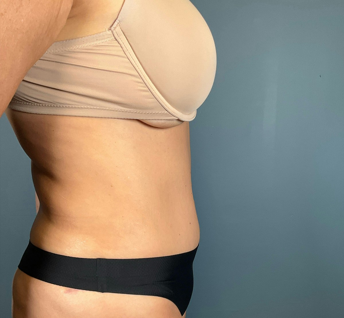 Tummy Tuck Before & After Gallery - Patient 414282 - Image 6