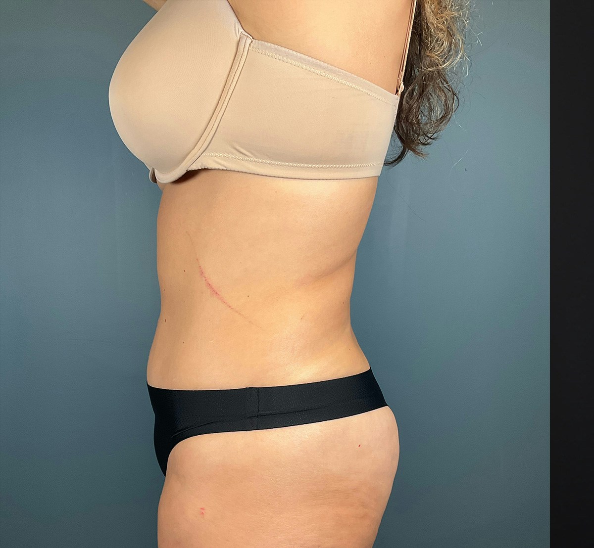 Tummy Tuck Before & After Gallery - Patient 414282 - Image 8