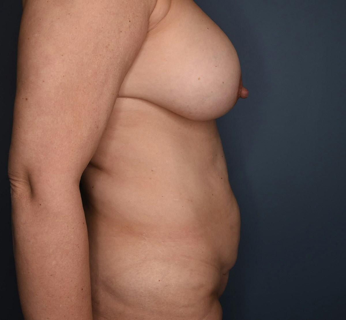Tummy Tuck Before & After Gallery - Patient 414282 - Image 5