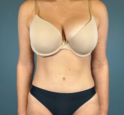 Tummy Tuck Before & After Gallery - Patient 414282 - Image 2