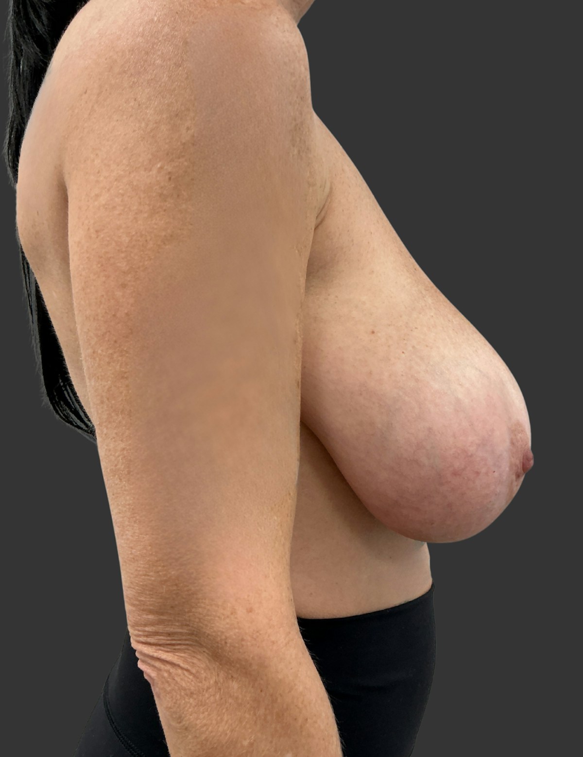 Breast Reduction Before & After Gallery - Patient 413334 - Image 5
