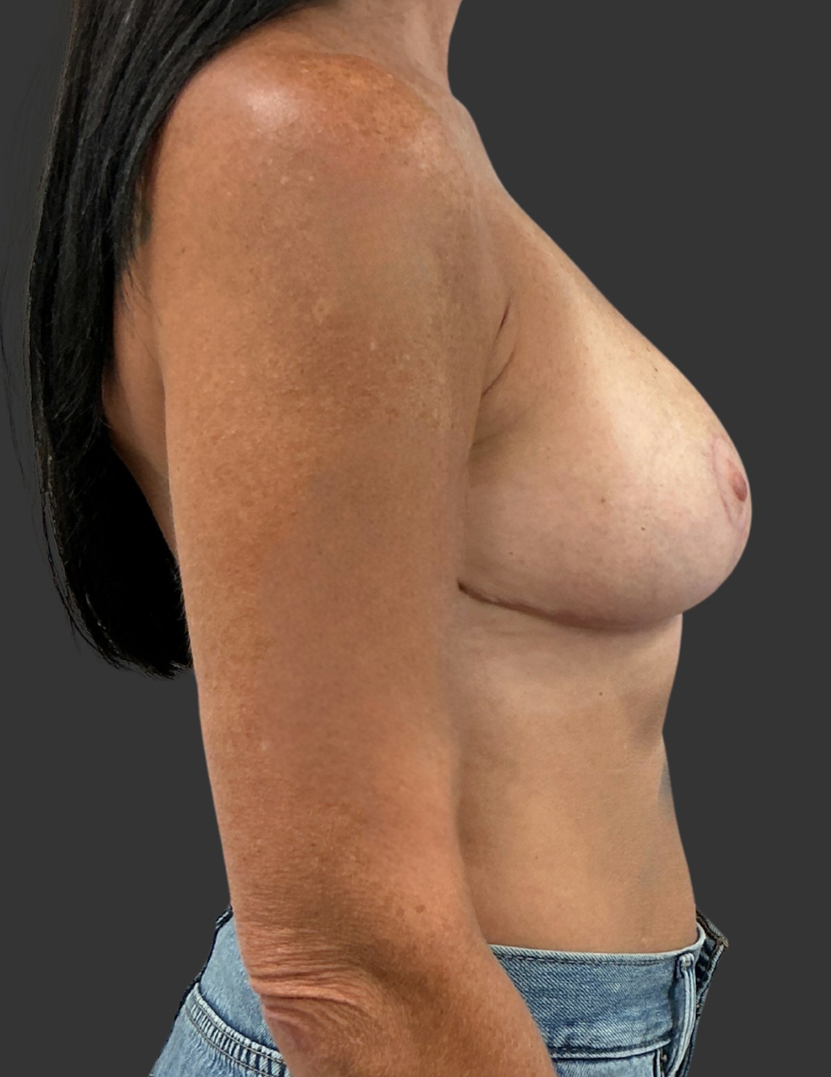 Breast Reduction Before & After Gallery - Patient 413334 - Image 6