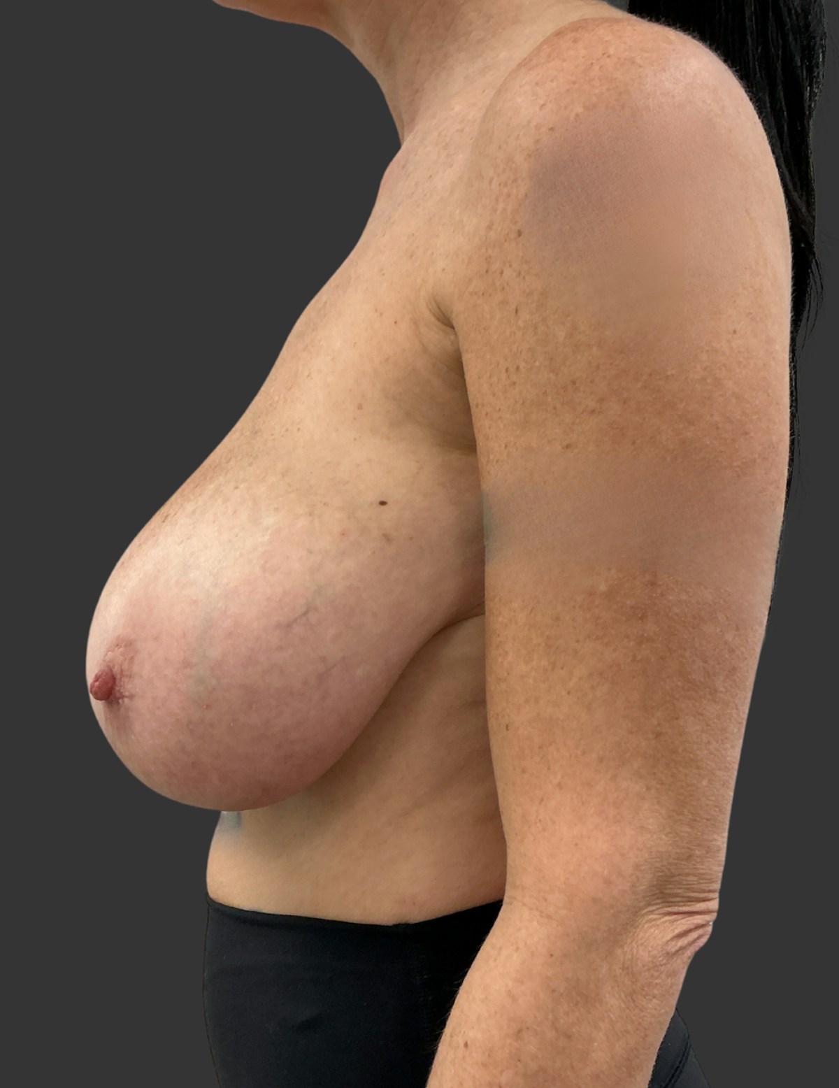 Breast Reduction Before & After Gallery - Patient 413334 - Image 7