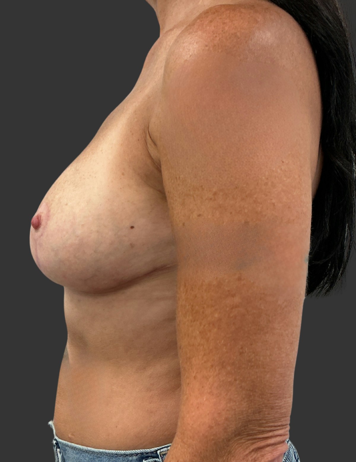 Breast Reduction Before & After Gallery - Patient 413334 - Image 8