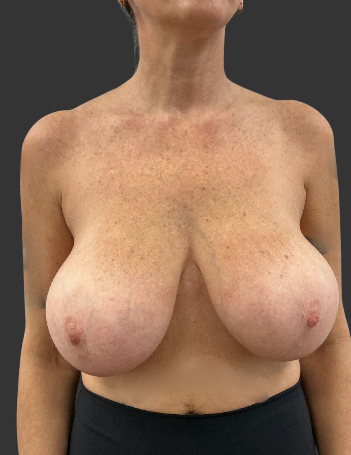 Breast Reduction Before & After Gallery - Patient 413334 - Image 9