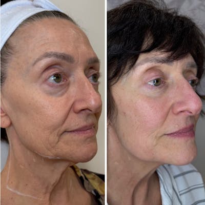 Agnes and Scarlet RF Before & After Gallery - Patient 470083 - Image 1