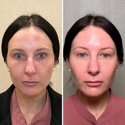 CoolPeel Before & After Gallery - Patient 750331 - Image 1