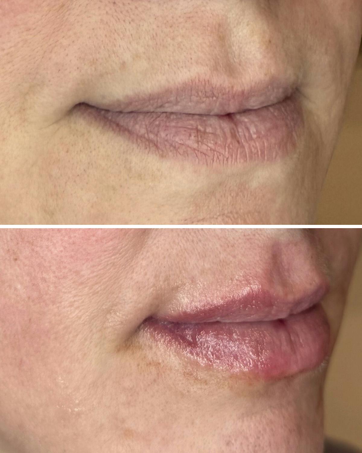 Lip Filler Before & After Gallery - Patient 355544 - Image 2
