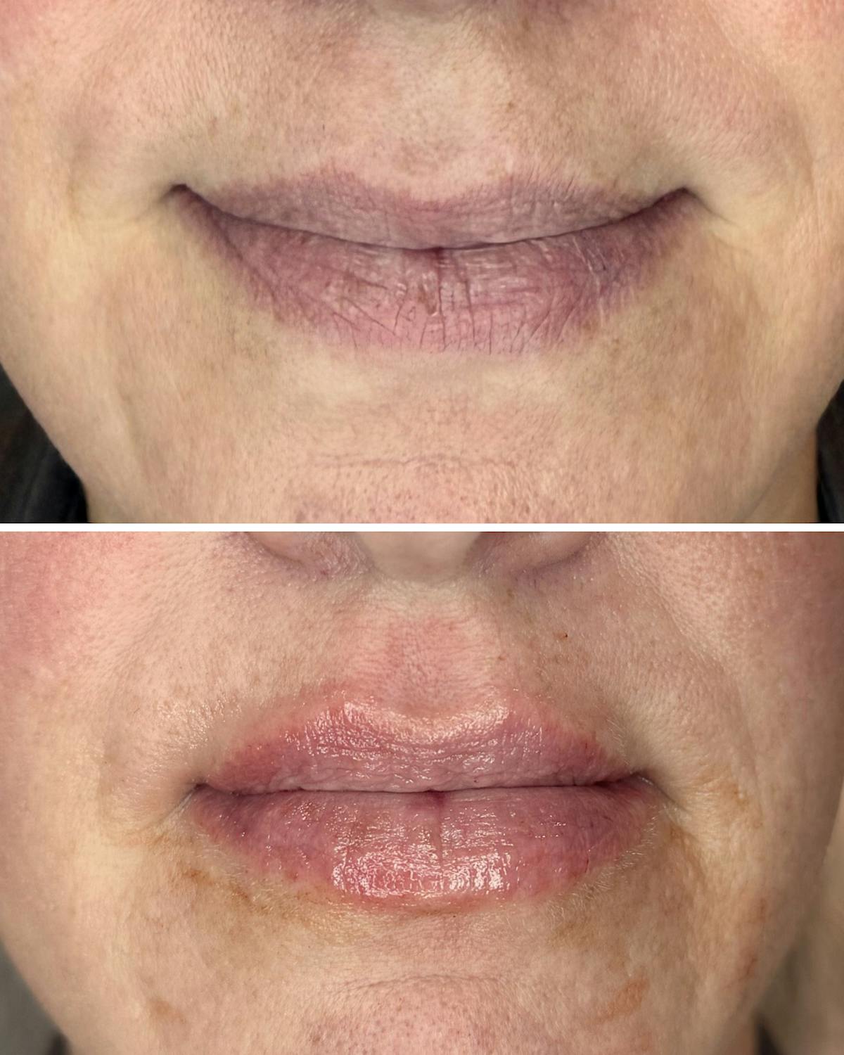Lip Filler Before & After Gallery - Patient 355544 - Image 1