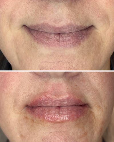 Lip Filler Before & After Gallery - Patient 355544 - Image 1