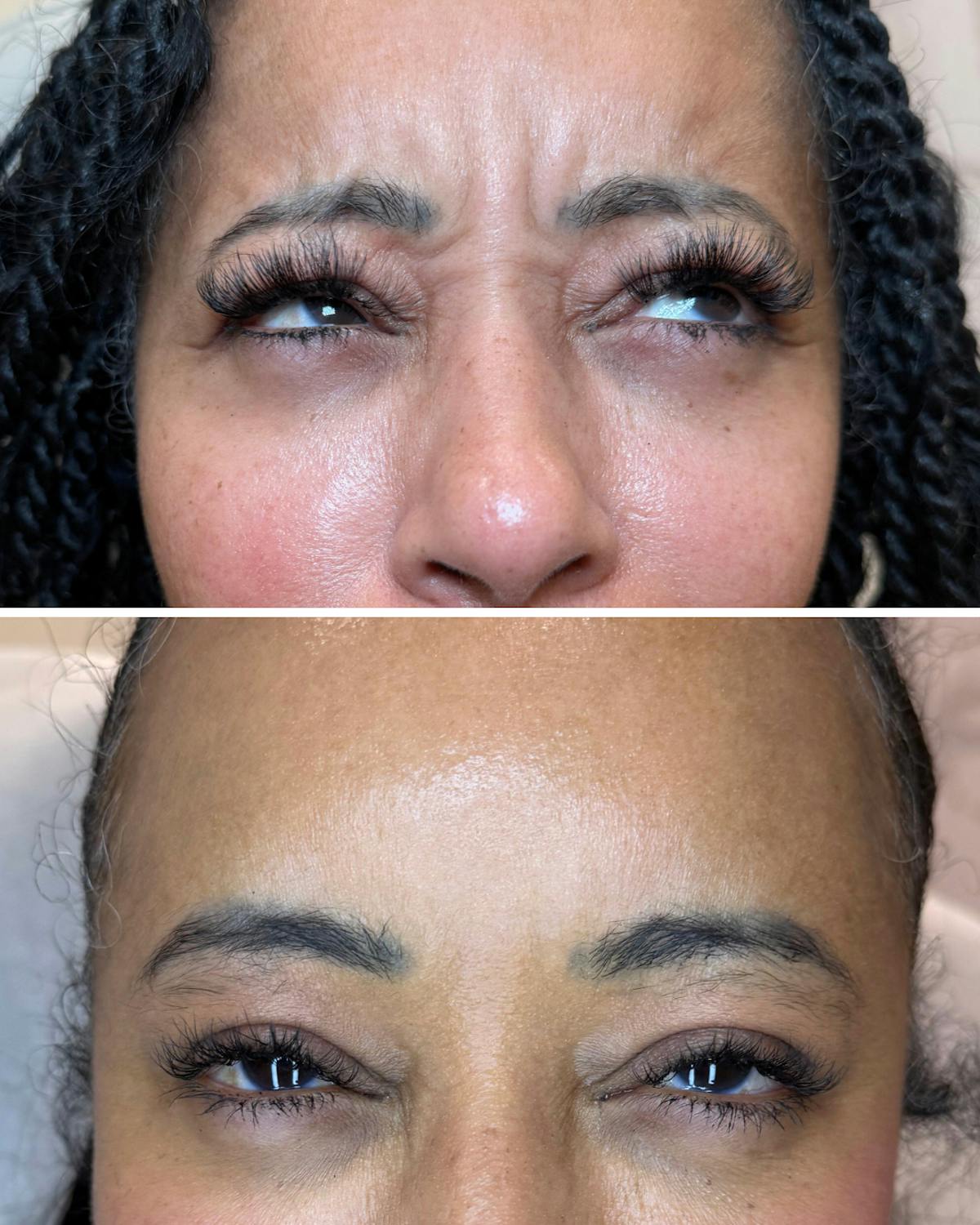 Botox Before & After Gallery - Patient 184818 - Image 1