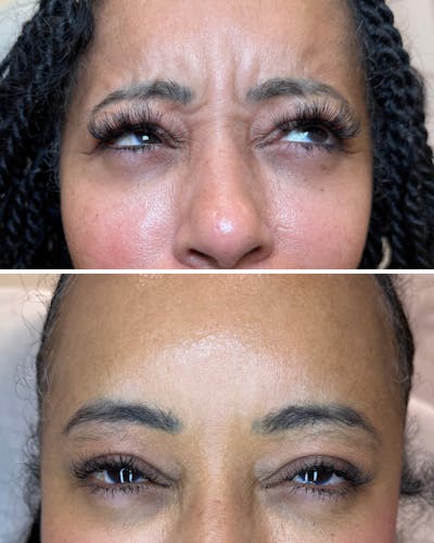 Botox Before & After Gallery - Patient 184818 - Image 1