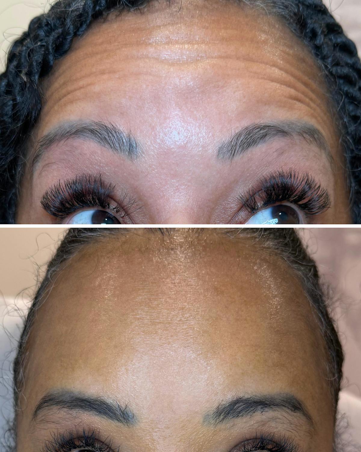 Botox Before & After Gallery - Patient 184818 - Image 2