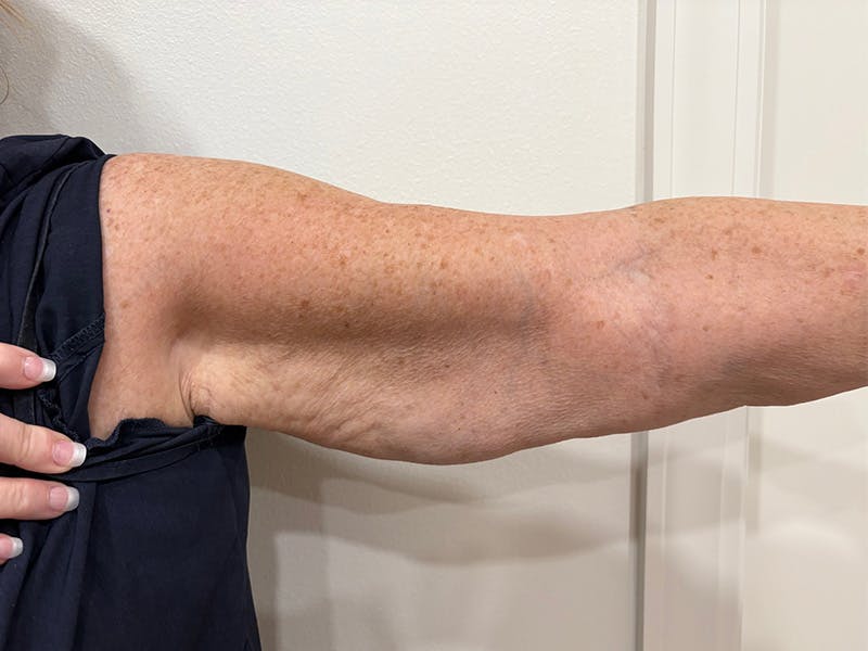 Everesse Before & After Gallery - Patient 226404 - Image 1