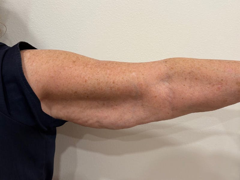 Everesse Before & After Gallery - Patient 226404 - Image 2