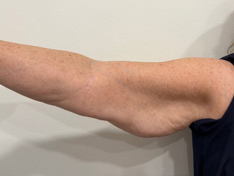 Everesse Before & After Gallery - Patient 226404 - Image 3